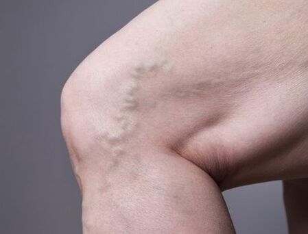 Varices