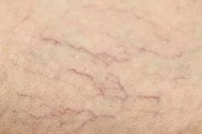 Étoiles vasculaires