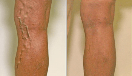 varices aux stades 1 et 3 de développement