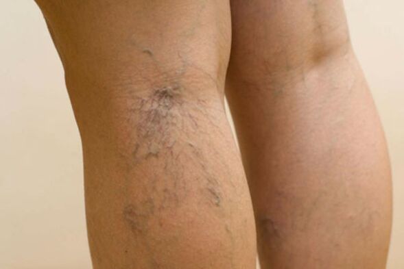 varices dans les jambes des femmes