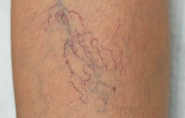 varices sur les jambes chez les femmes