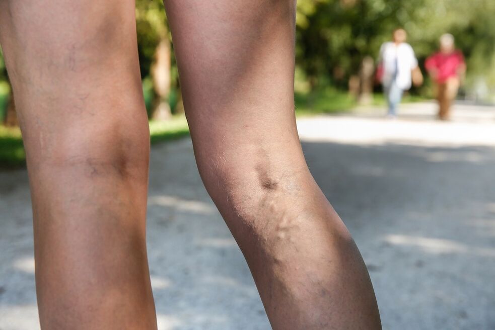 varices sur les jambes