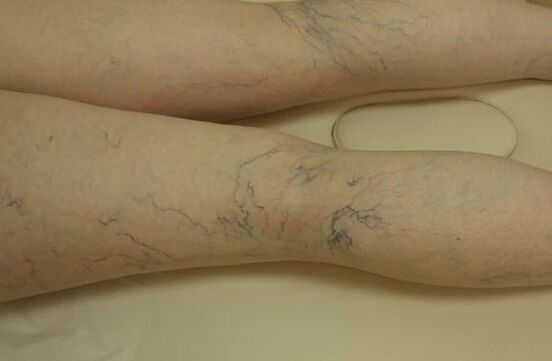 Varicose étoiles sur les jambes