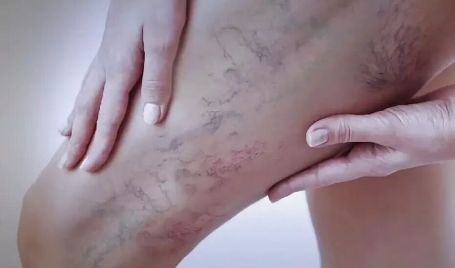 Étoiles sur les jambes avec des varices