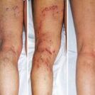 Varices des jambes