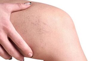 stades de développement des varices