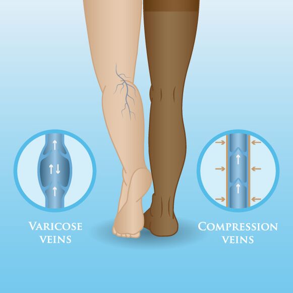 Effets des vêtements de compression sur les varices des jambes