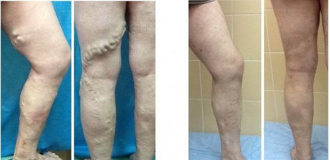 Jambes avant et après oblitération par radiofréquence des veines avec varices