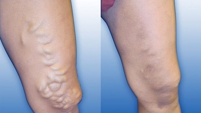 Jambes avant et après traitement des varices sévères