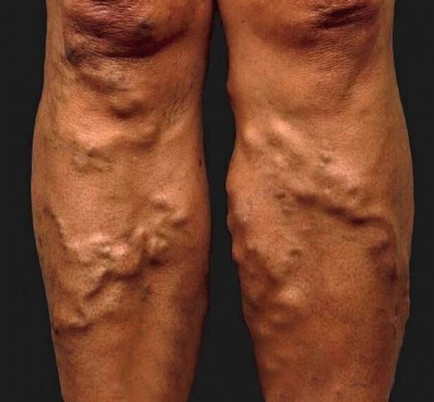 varices négligées sur les jambes