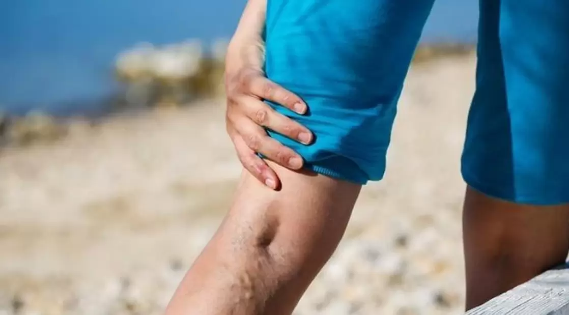 Les veines bleues bombées sur les jambes sont un signe de varices